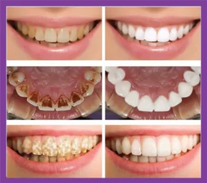 معجون الأسنان المبيض البنفسجي eelhoe purple اشتري حبه وحصل على حبه مجان مع الفرشة